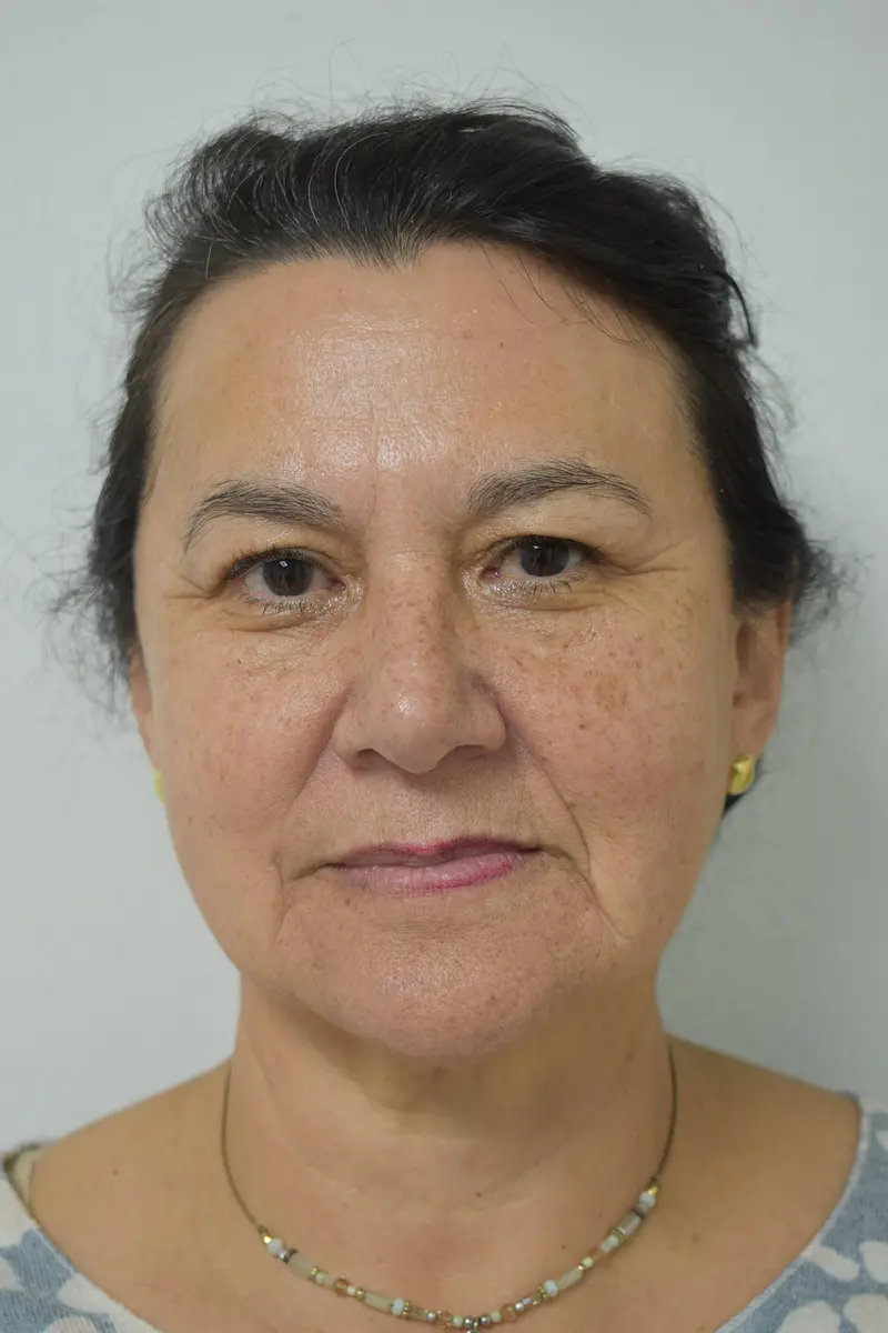 Antes blefaroplastia sin cirugía - párpados caídos NutraPiel