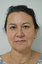 Blefaroplastia sin cirugía - Miniatura 1