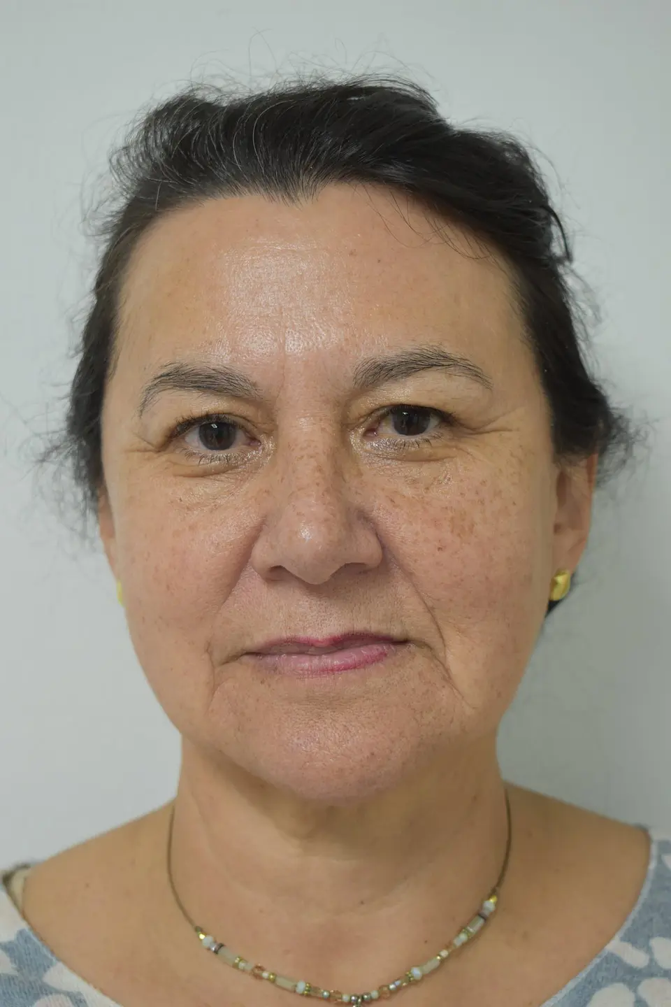 Blefaroplastia sin cirugía 1