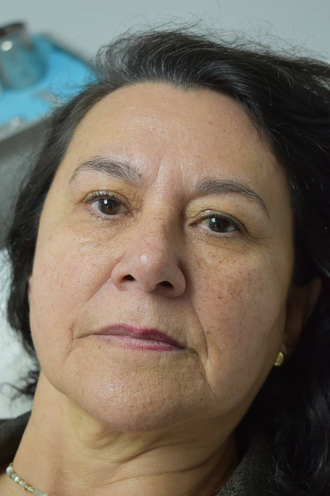 Blefaroplastia sin cirugía