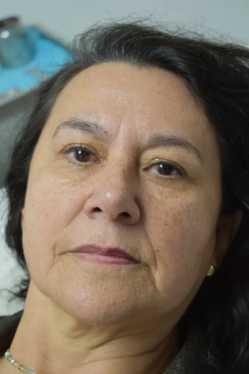 Después blefaroplastia sin cirugía - mirada descansada NutraPiel