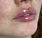 Labios perfectos con ácido hialurónico - Miniatura 2