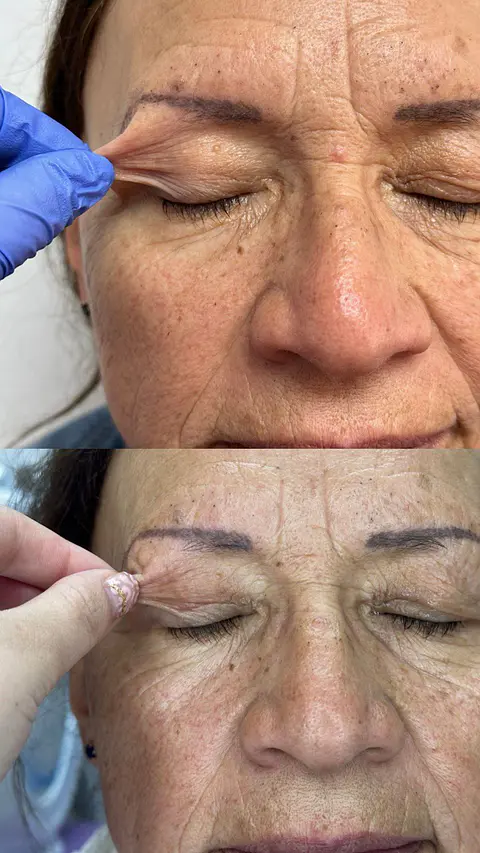 Blefaroplastia sin cirugía con Plasmed