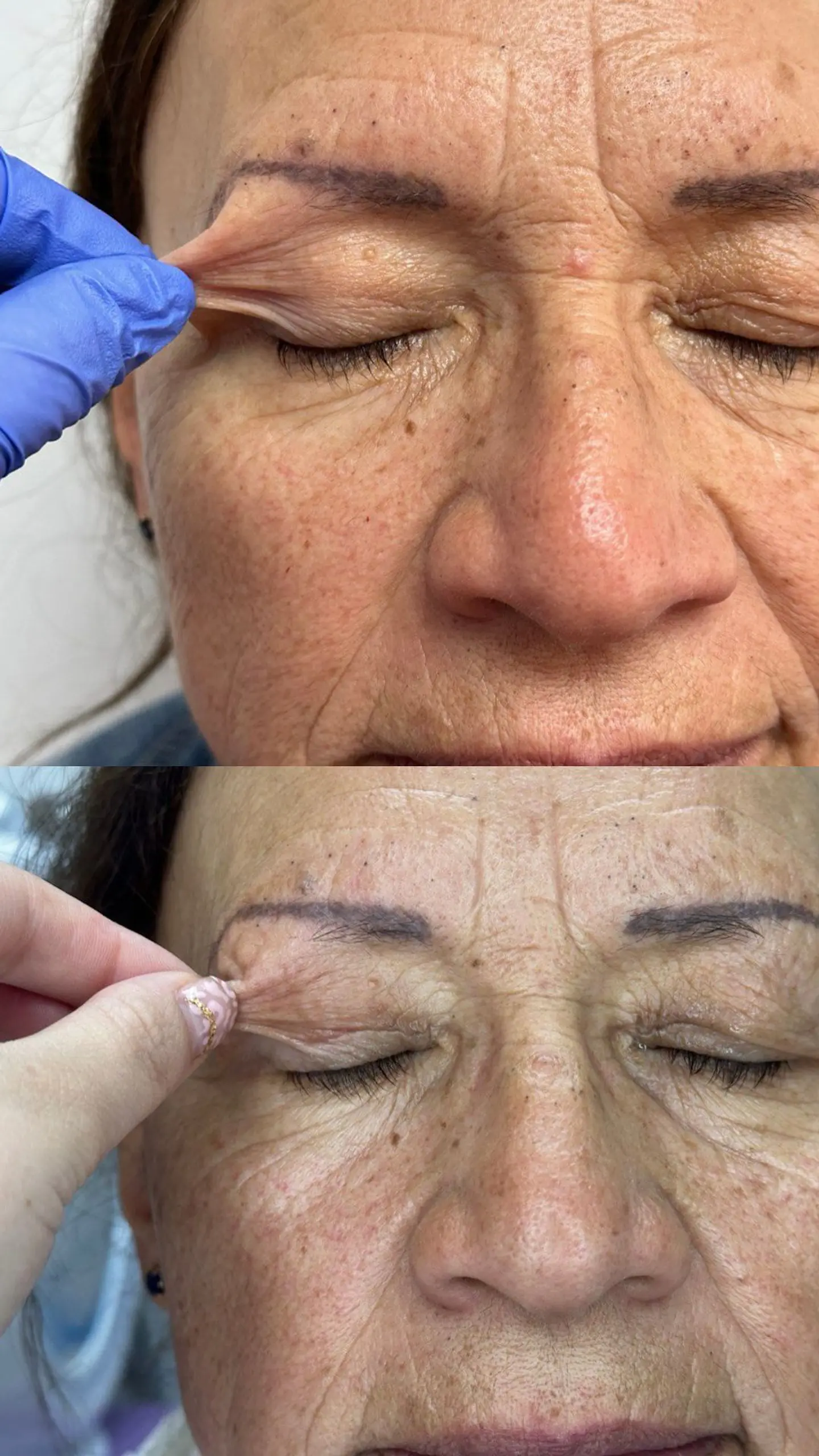 Blefaroplastia sin cirugía con Plasmed 1