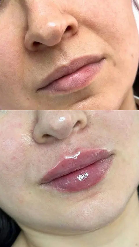 Labios perfectos con ácido hialurónico