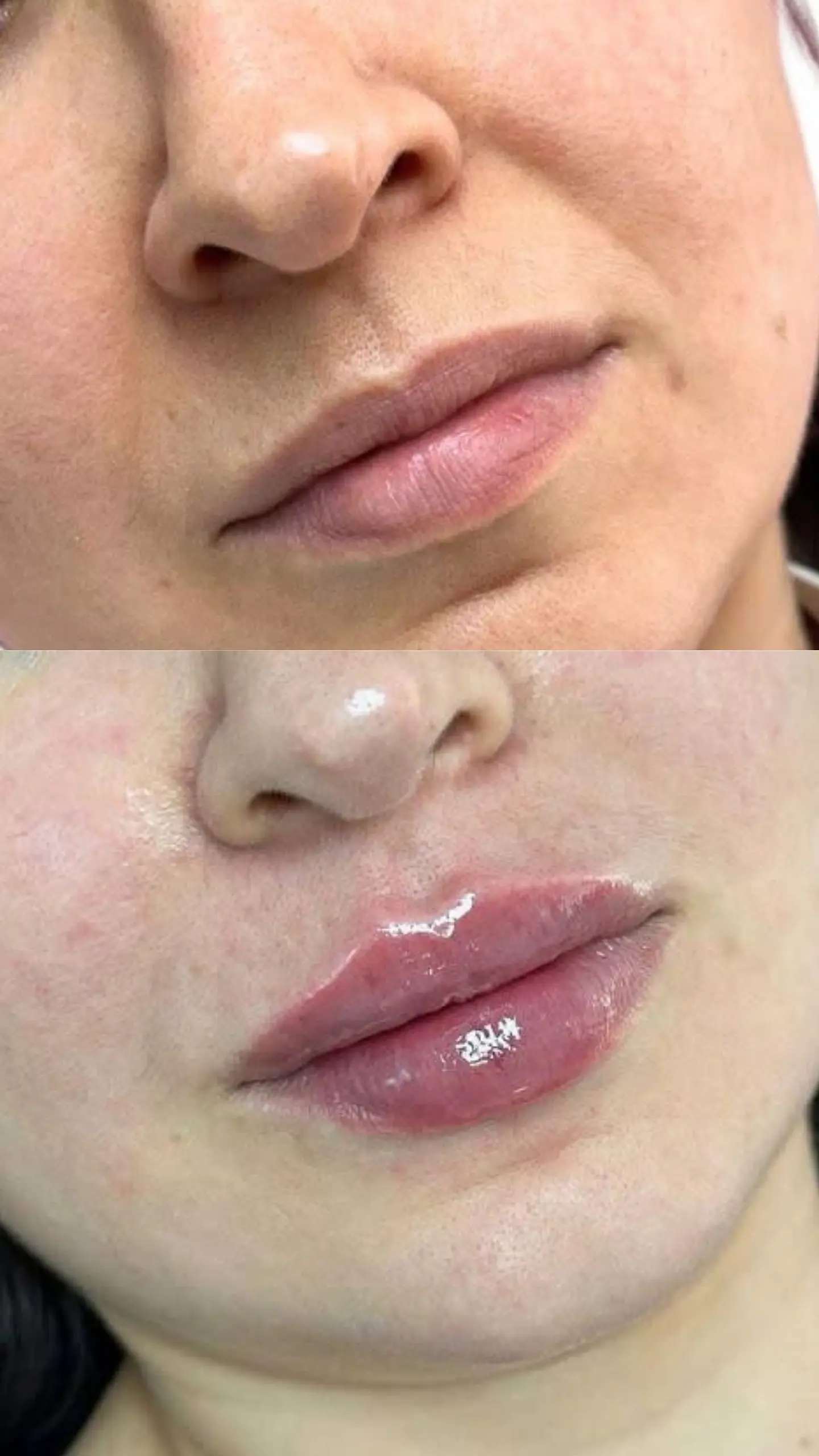 Labios perfectos con ácido hialurónico 1