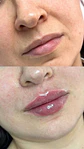 Labios perfectos con ácido hialurónico - Miniatura 1