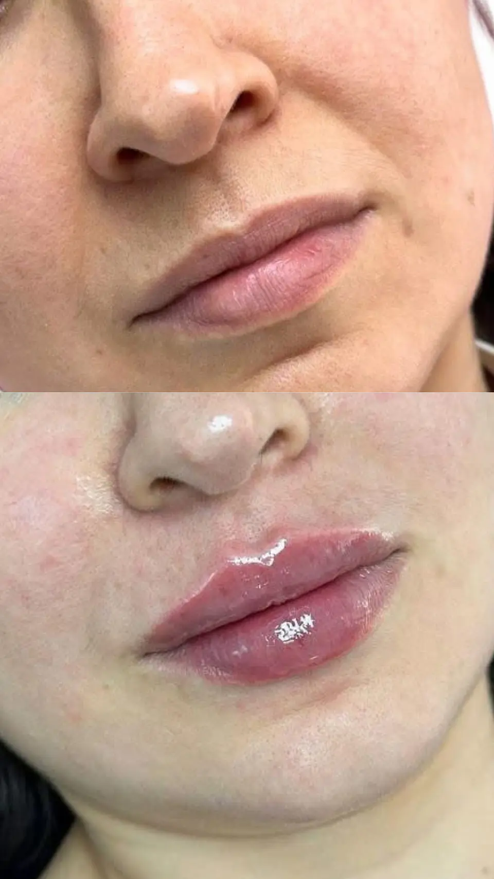 Labios perfectos con ácido hialurónico 1