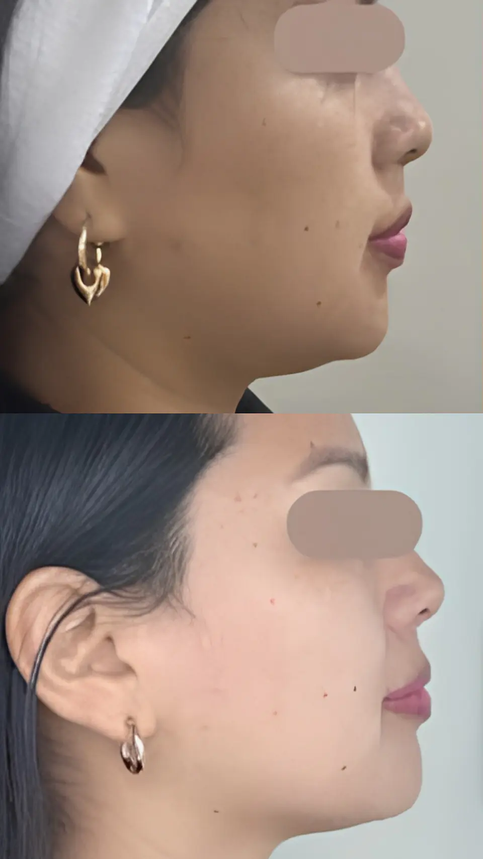 Lipo Papada 3