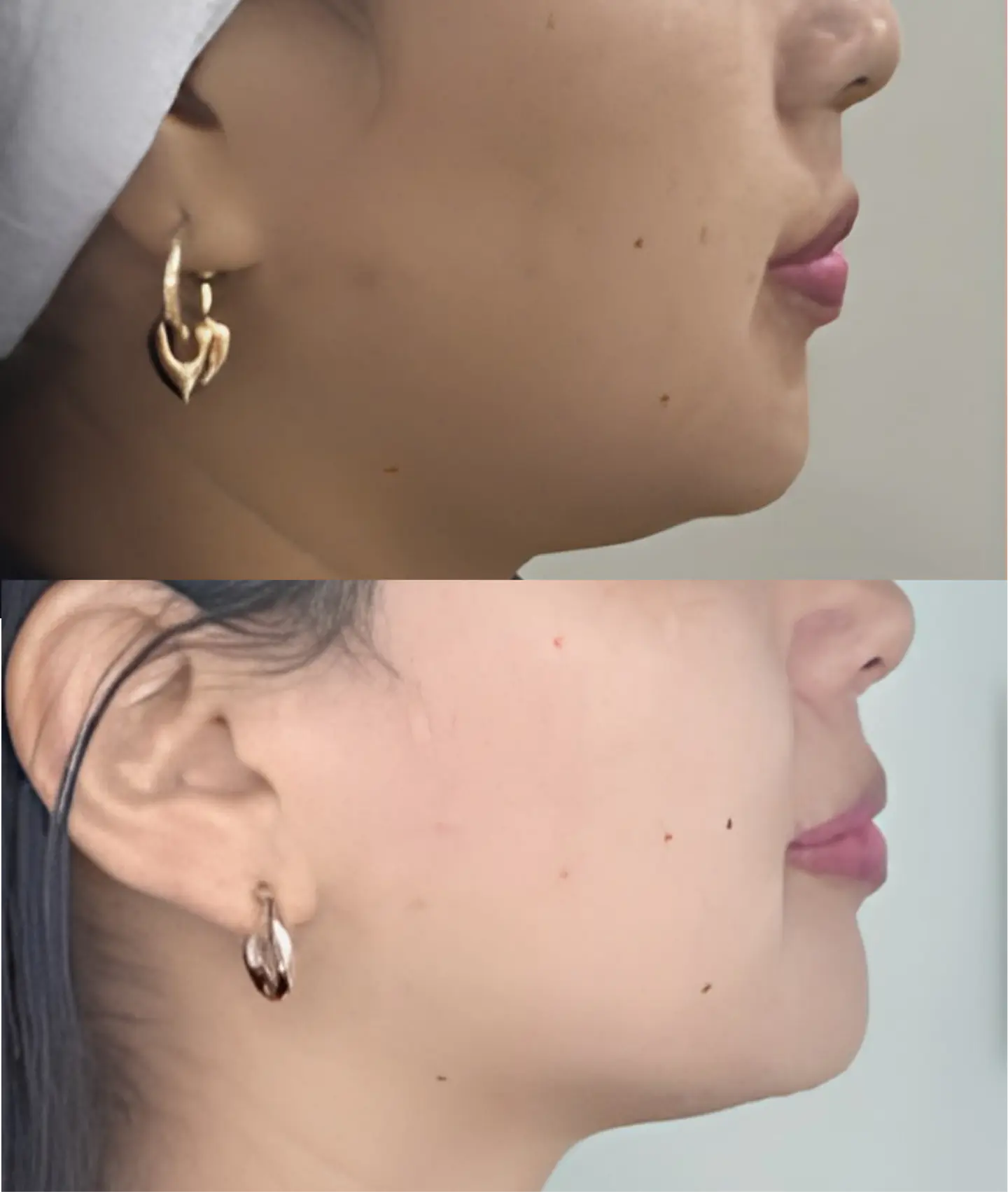 Lipo Papada 1