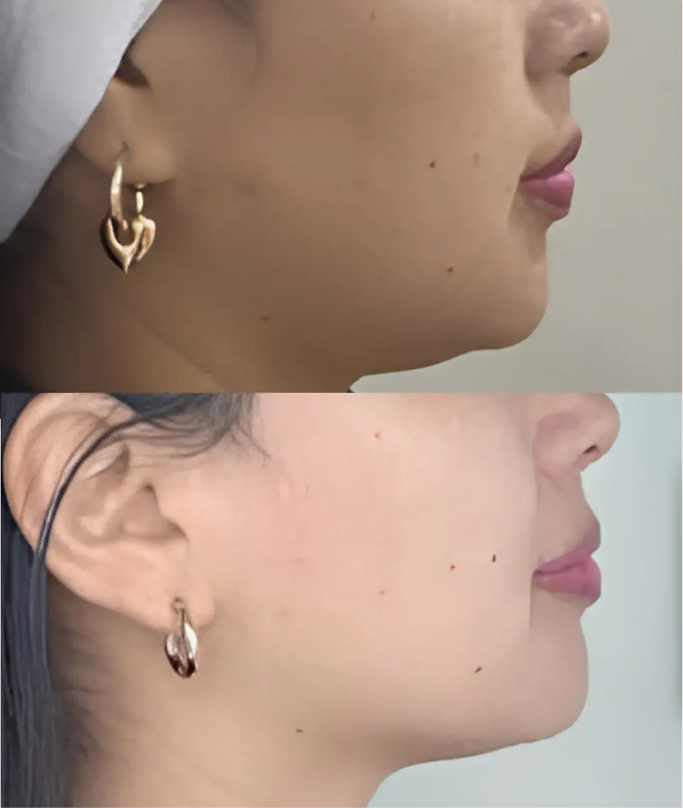 Lipo Papada 1