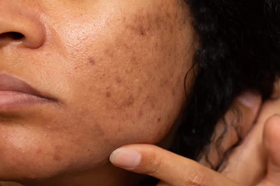 Programa Melasma Expert 1