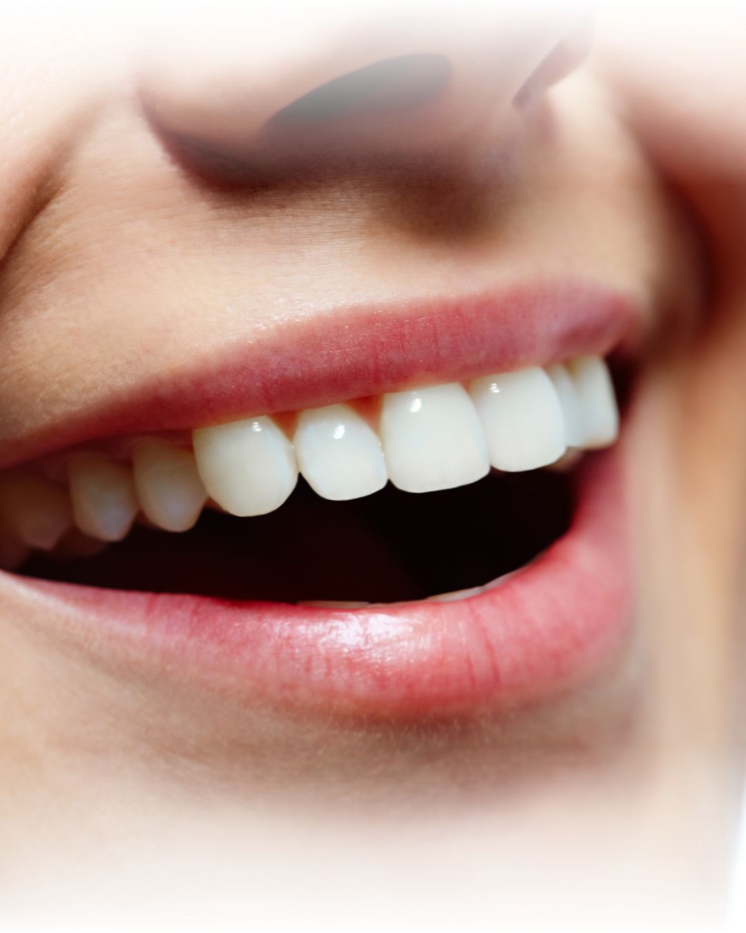 Diseño de Sonrisa 6 carillas