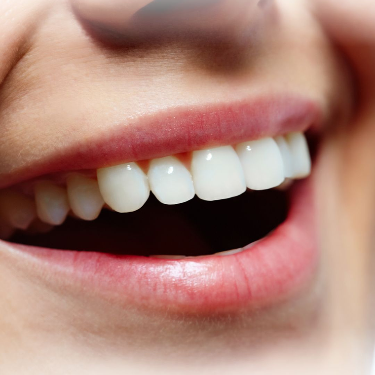 Diseño de Sonrisa 6 carillas 1