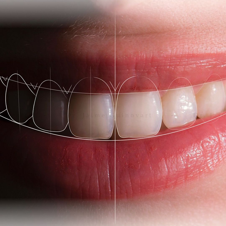 Diseño de Sonrisa 20 Carillas  1