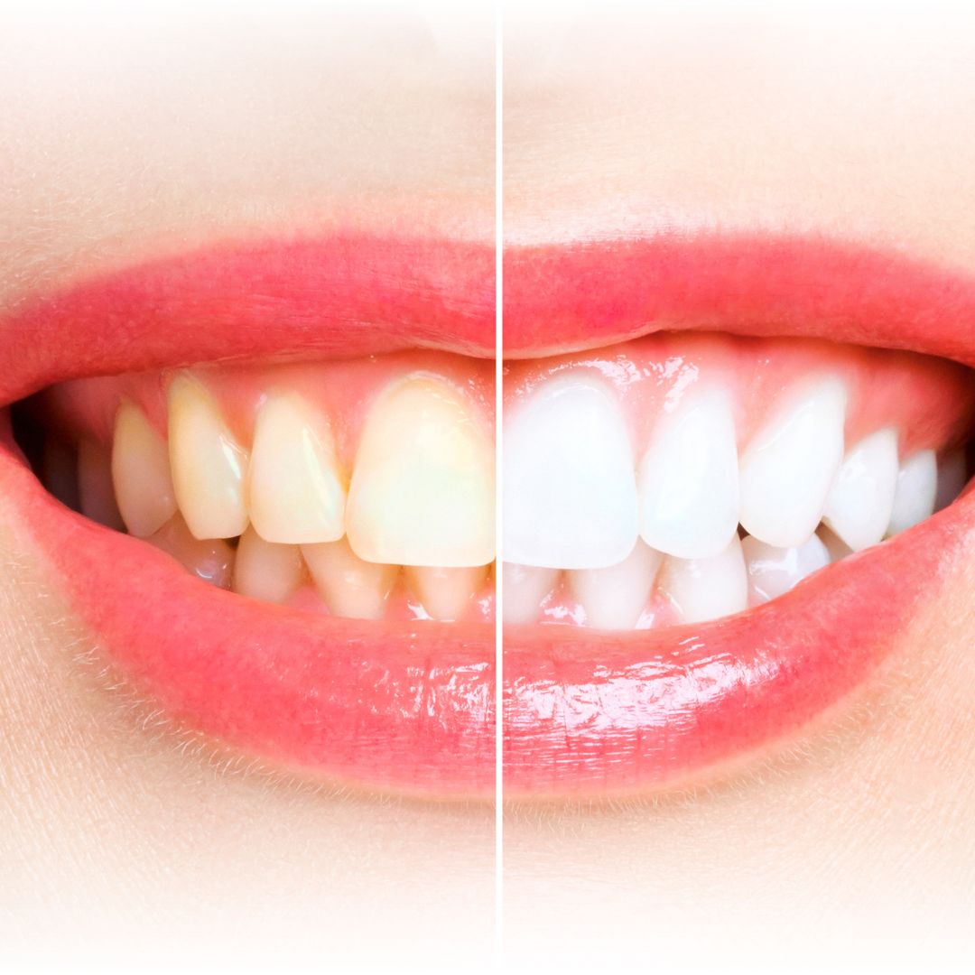 Blanqueamiento Dental