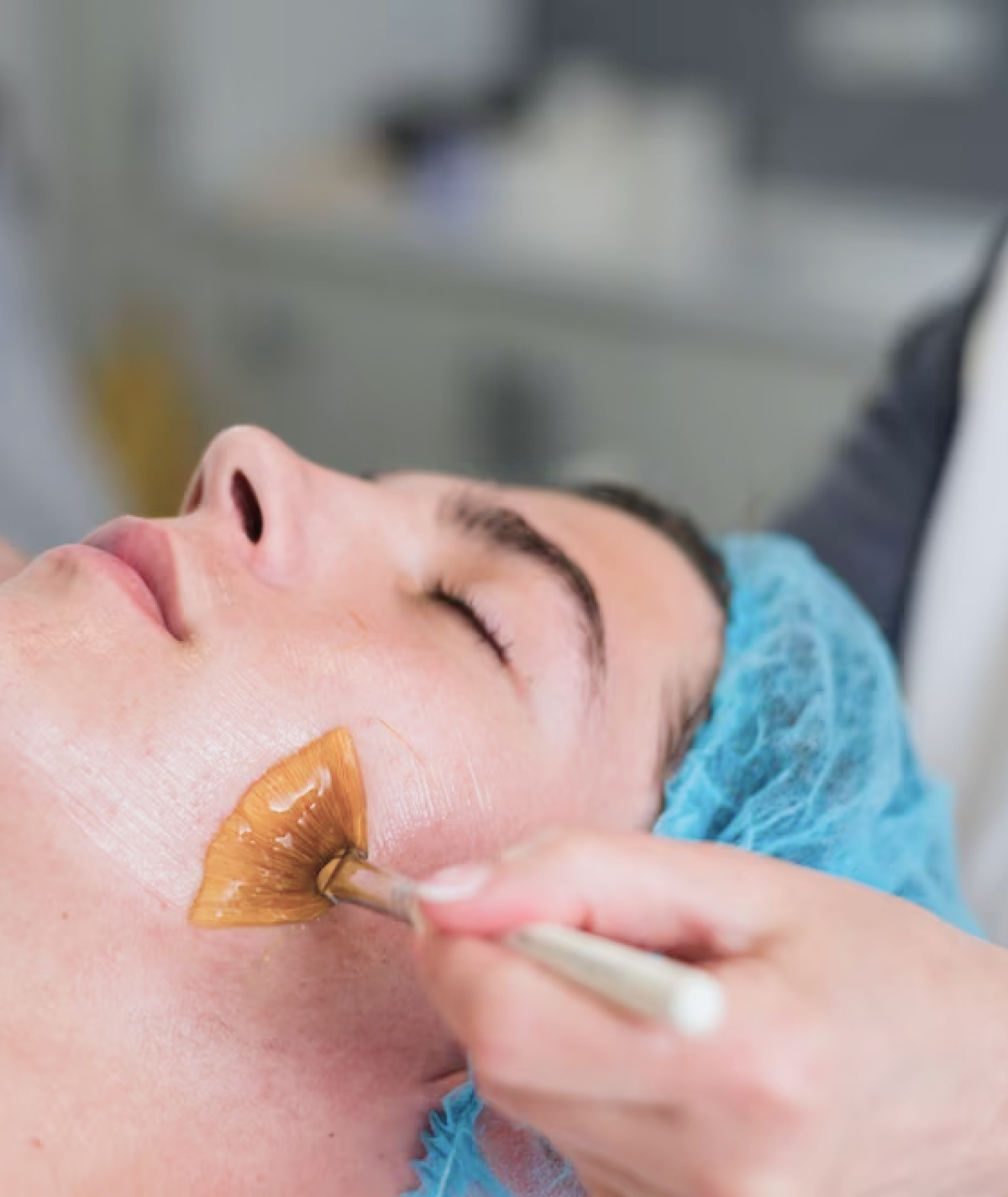 Peeling Químico