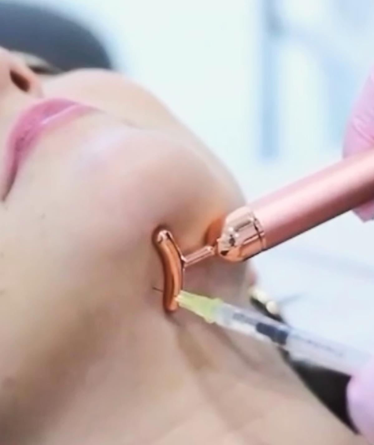 Mesoterapia Corporal (Lipolíticos)