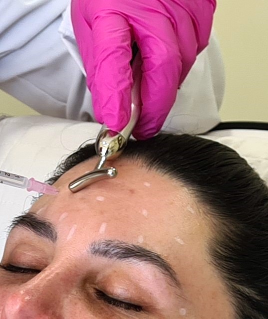 Toxina Botulínica en 3 zonas