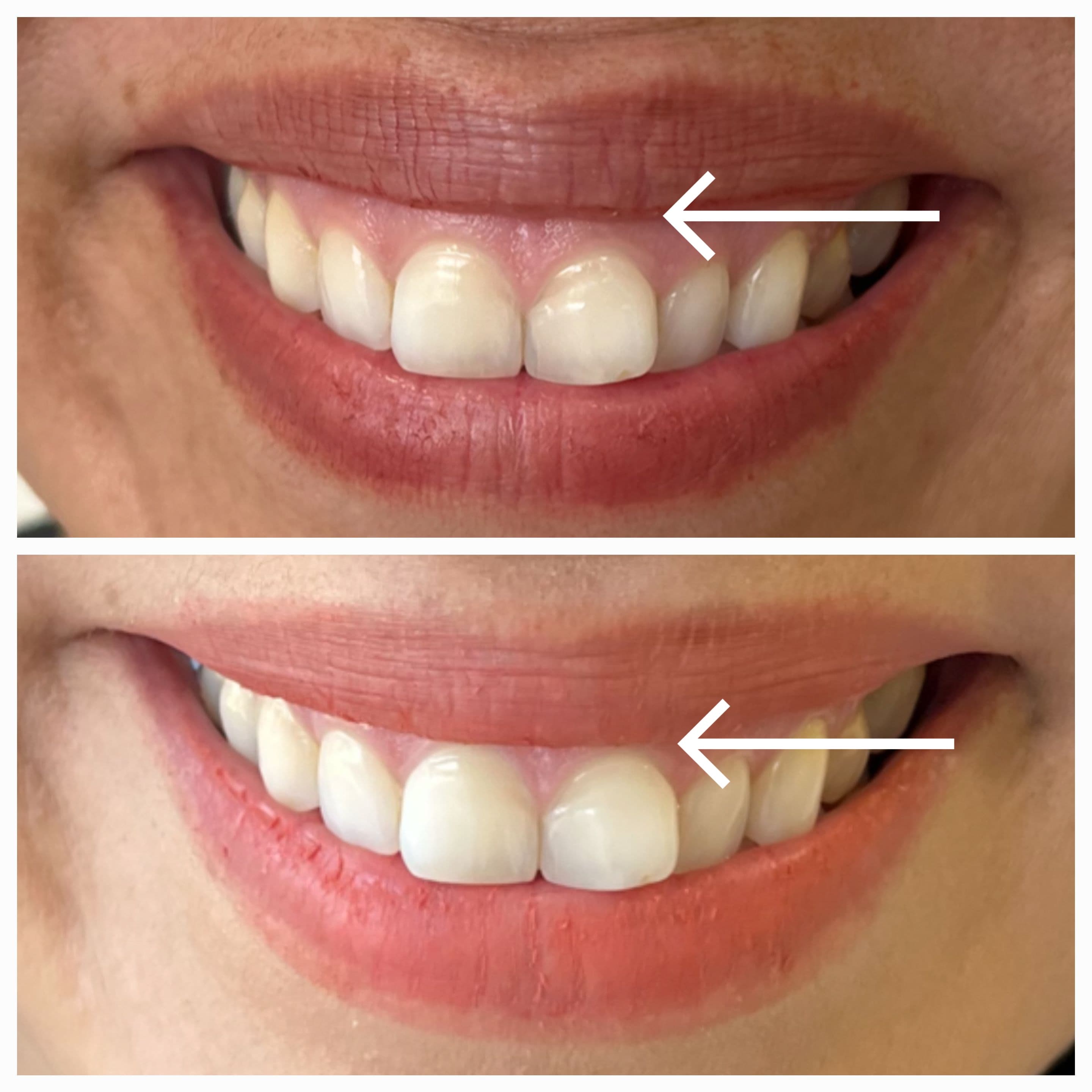 Sonrisa Gingival