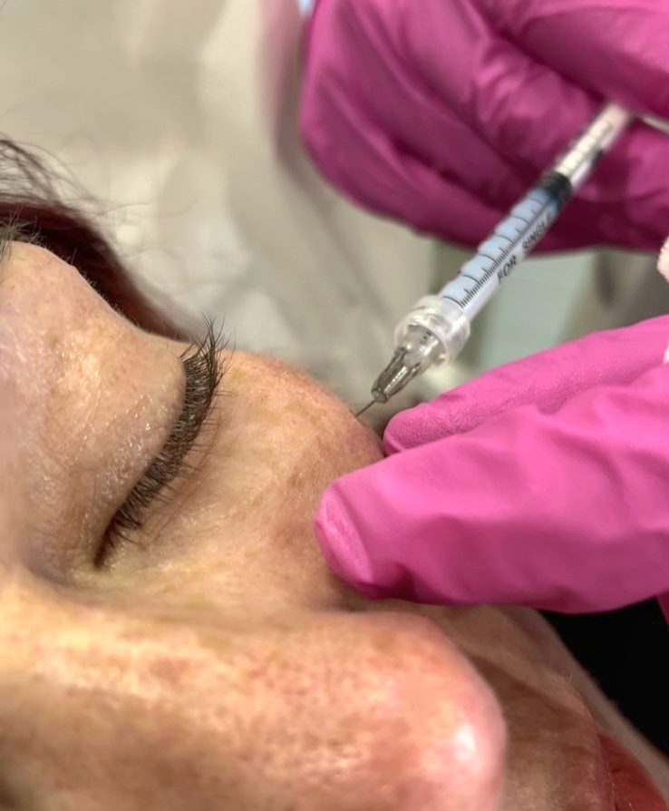 Tratamiento para Ojeras