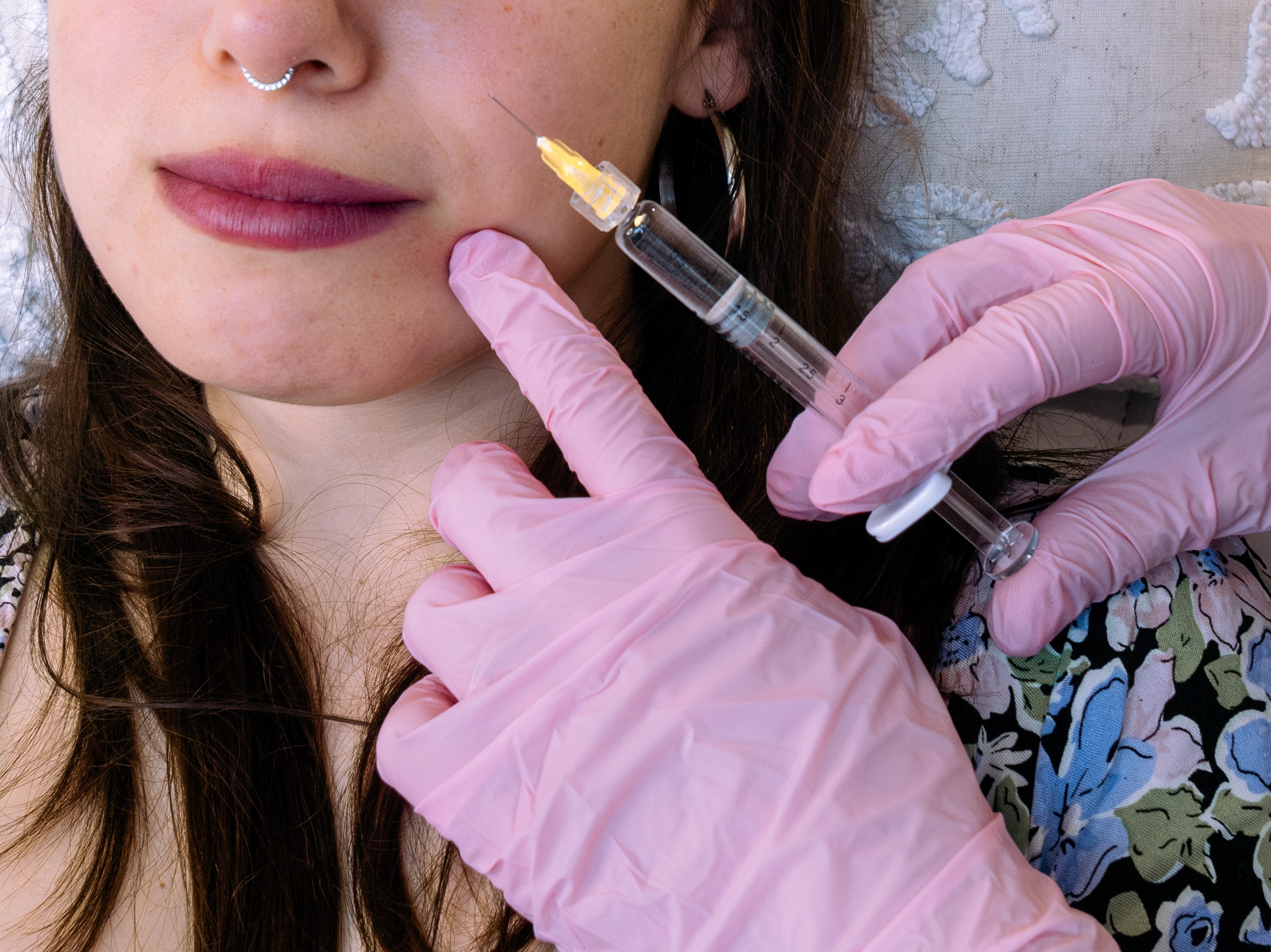 Botox + 1 Jeringa de Ácido Hialurónico