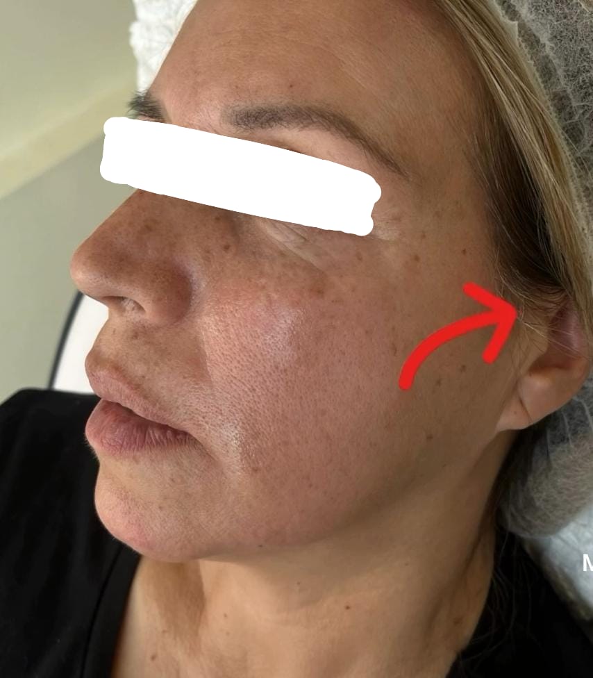 Efecto Roma / 1ml Ácido Hialurónico