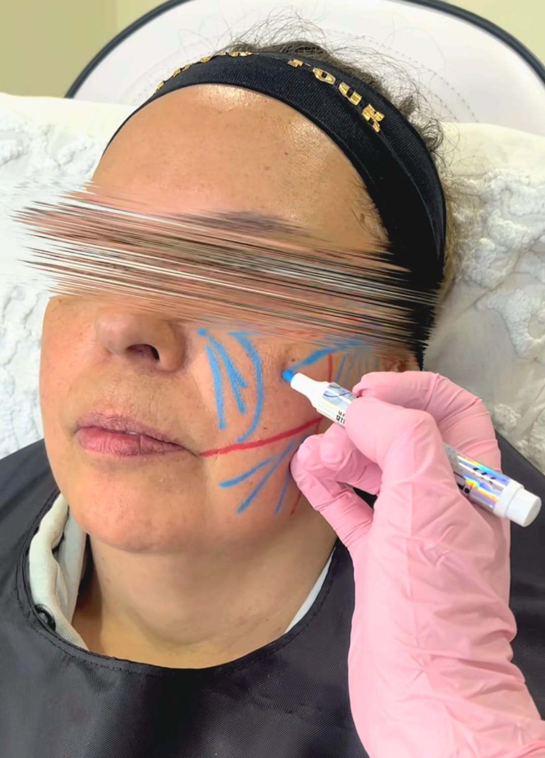 Adipoestructuración facial