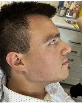 REBORDE MADIBULAR CON HIDROXIAPATITA DE CALCIO