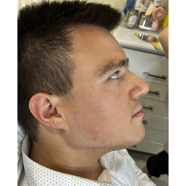 REBORDE MADIBULAR CON HIDROXIAPATITA DE CALCIO