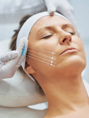 Hilos Tensores 4 unidades