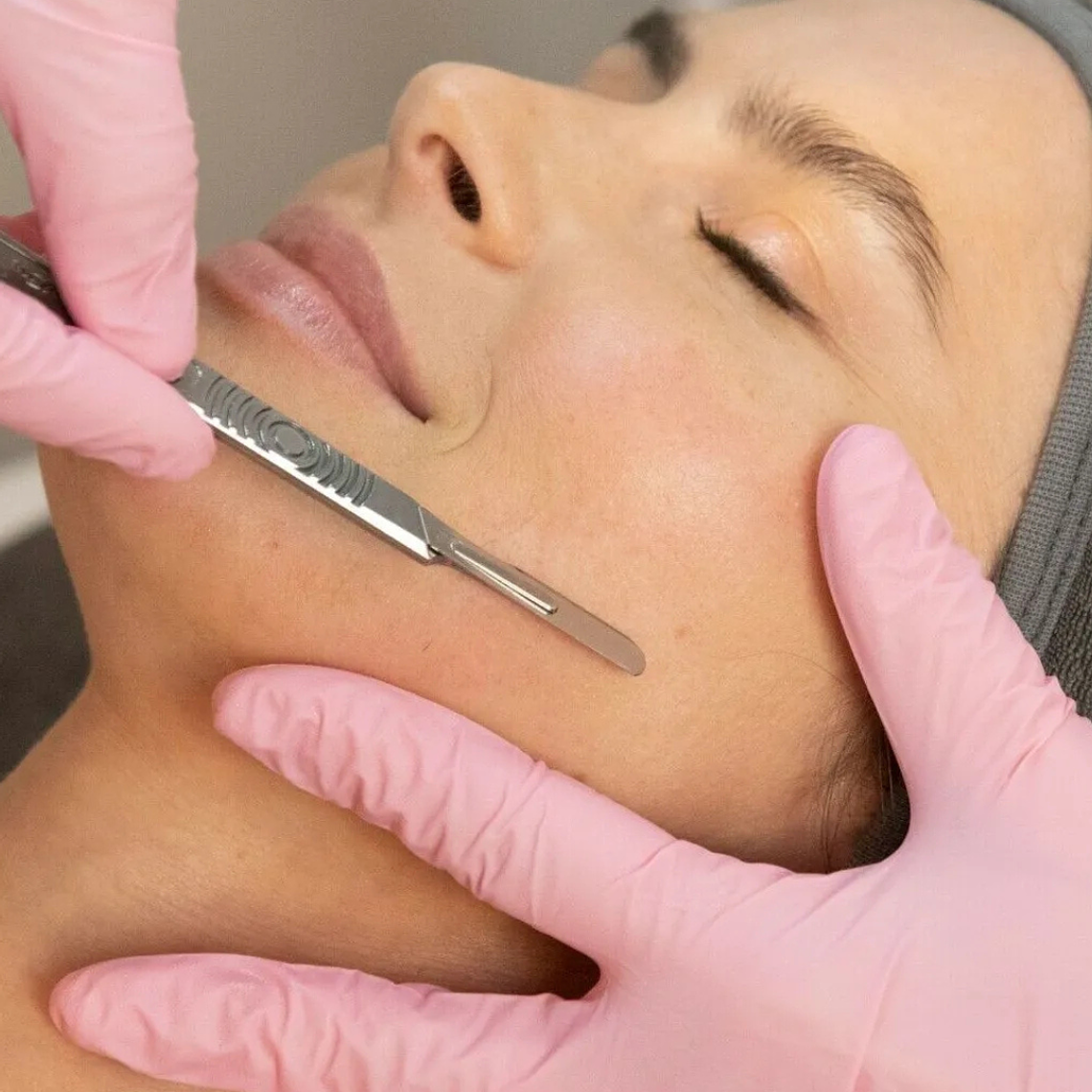 Dermaplaning – 3 sesiones 1