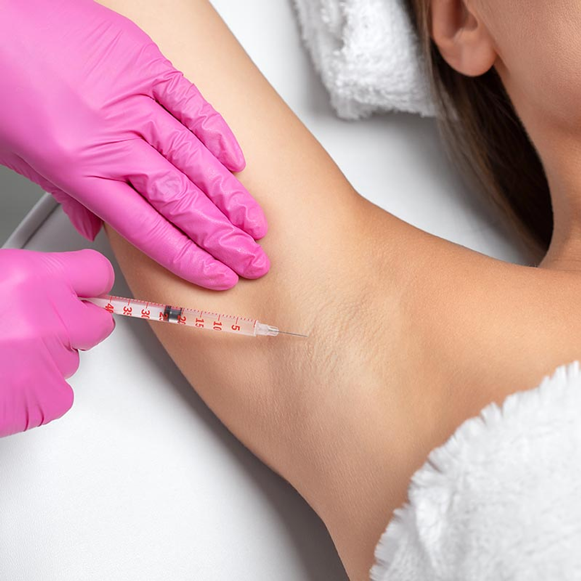 HIPERHIDROSIS AXILAR Y PALMAR 1