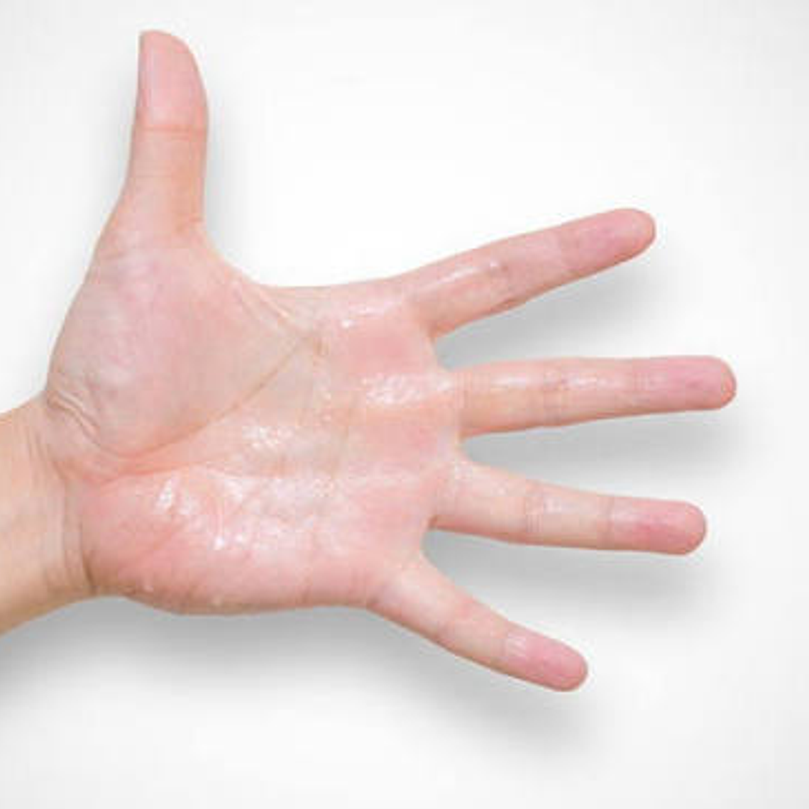 HIPERHIDROSIS PALMAR  1