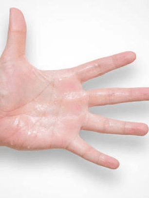 HIPERHIDROSIS PALMAR 