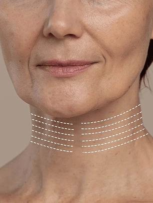 Cuello - Hilos revitalizantes (desde 20 unidades)