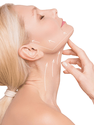 Papada - Hilos revitalizantes (desde 20 unidades)