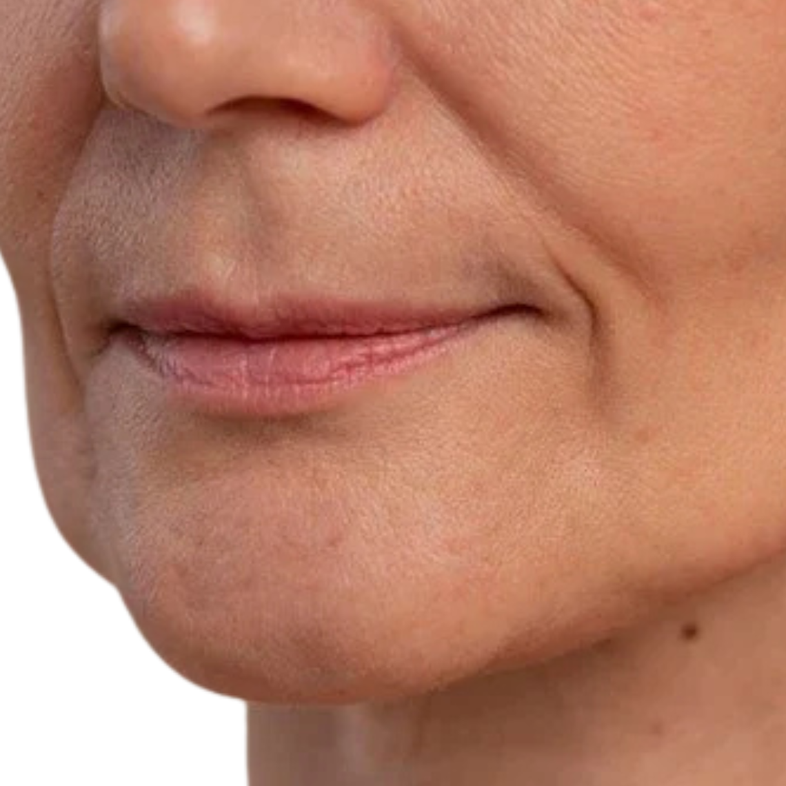 Surco nasogeniano - Hilos revitalizantes (desde 20 unidades) 1