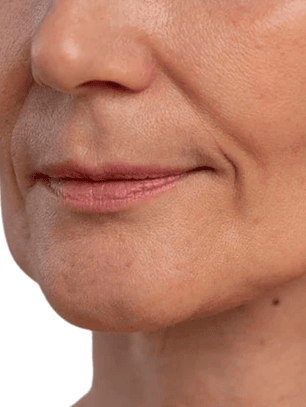 Surco nasogeniano - Hilos revitalizantes (desde 20 unidades)