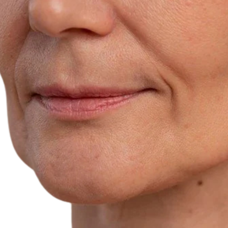 Surco nasogeniano - Hilos revitalizantes (desde 20 unidades) 1