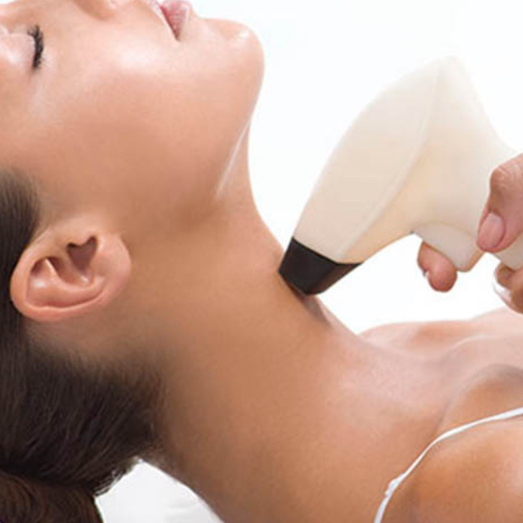 Radiofrecuencia papada - 8 sesiones 1