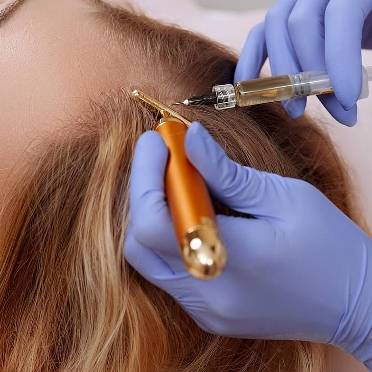 Plasma Rico en Plaquetas capilar  1