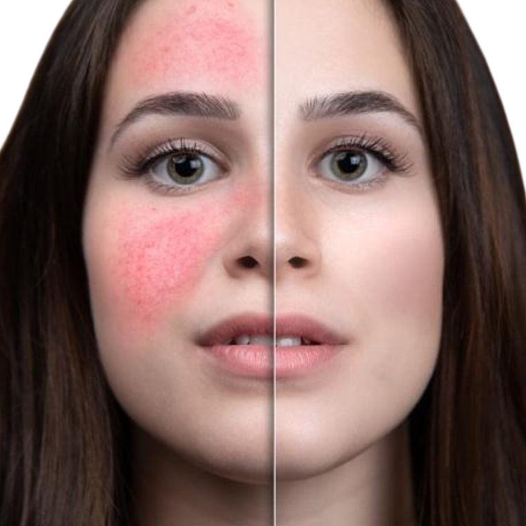 Láser IPL Rosácea  1