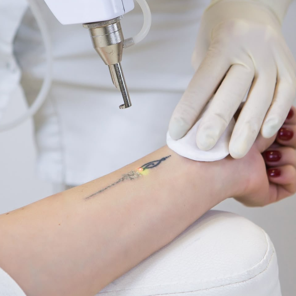 Eliminación de tatuajes con Láser ND YAG  1
