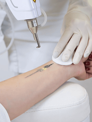 Eliminación de tatuajes con Láser ND YAG 