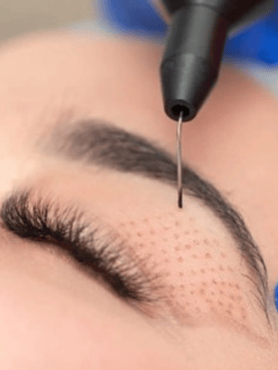 Beflaroplastía con Energía Plasmática 