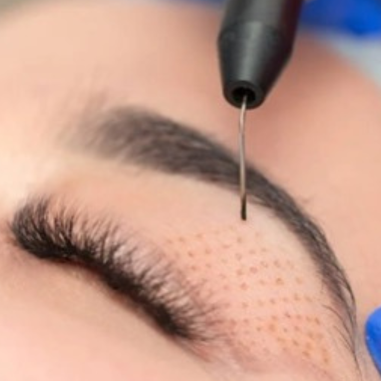 Beflaroplastía con Energía Plasmática  1