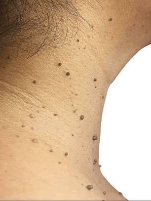 Eliminación de acrocordones con Energía Plasmática - hasta 10 lesiones