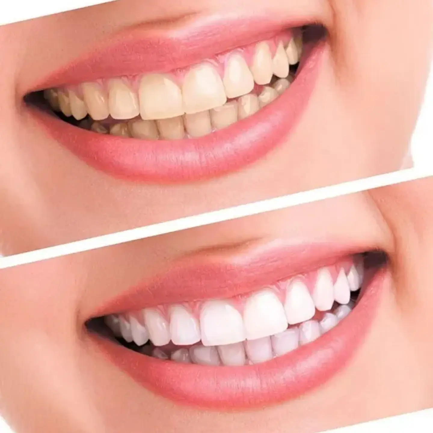 Pulidor y Blanqueador Dental Luma Smile - Sonrisa Blanca en Minutos 8