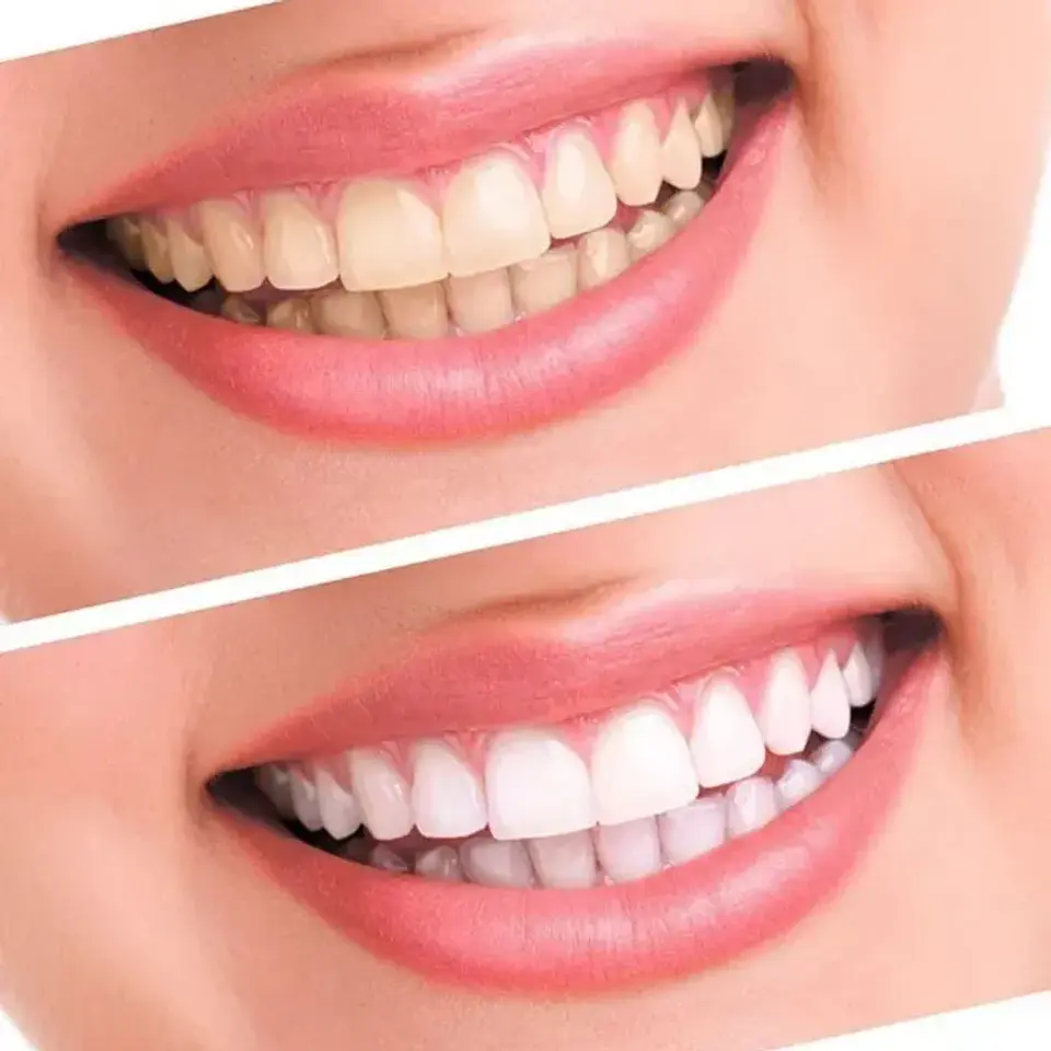Pulidor y Blanqueador Dental Luma Smile - Sonrisa Blanca en Minutos 8